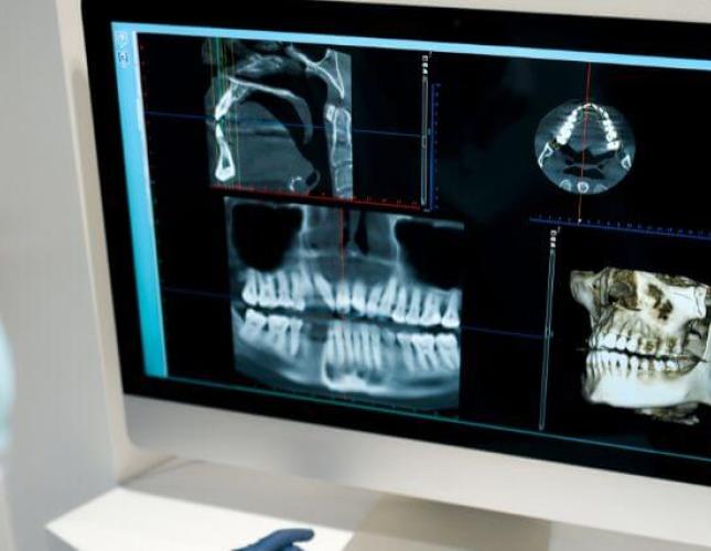 Dental X-Rays: The 4 Different Types and Their Use