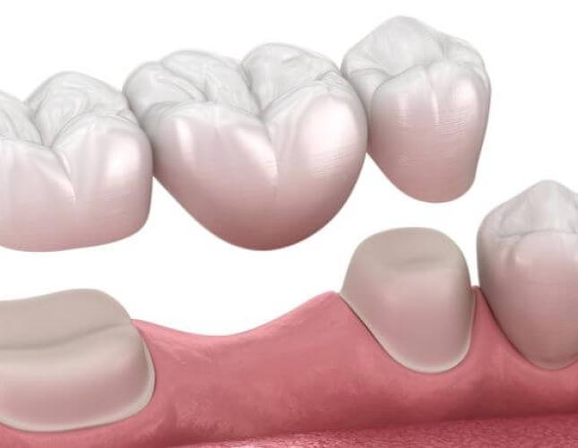 Dental Bridge Materials: Exploring Options for Aesthetic and Functional Results