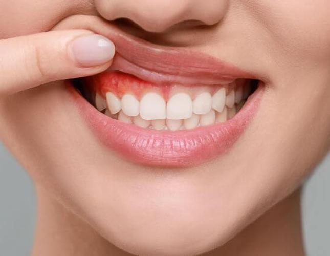 Genetic Factors in Periodontal Disease: Is Gum Health Hereditary?