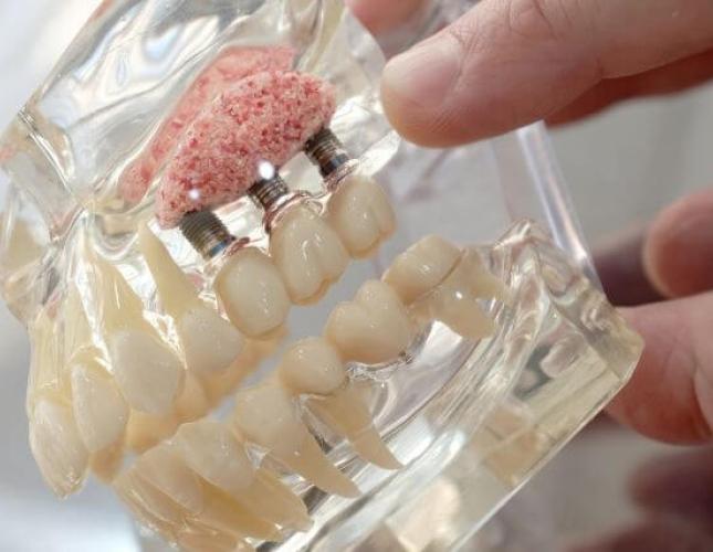 Sinus Lift Surgery: Making Dental Implants Possible